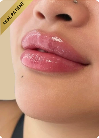 Lip Fillers