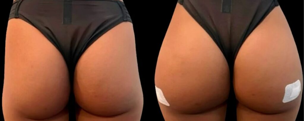 Before and after liquid BBL