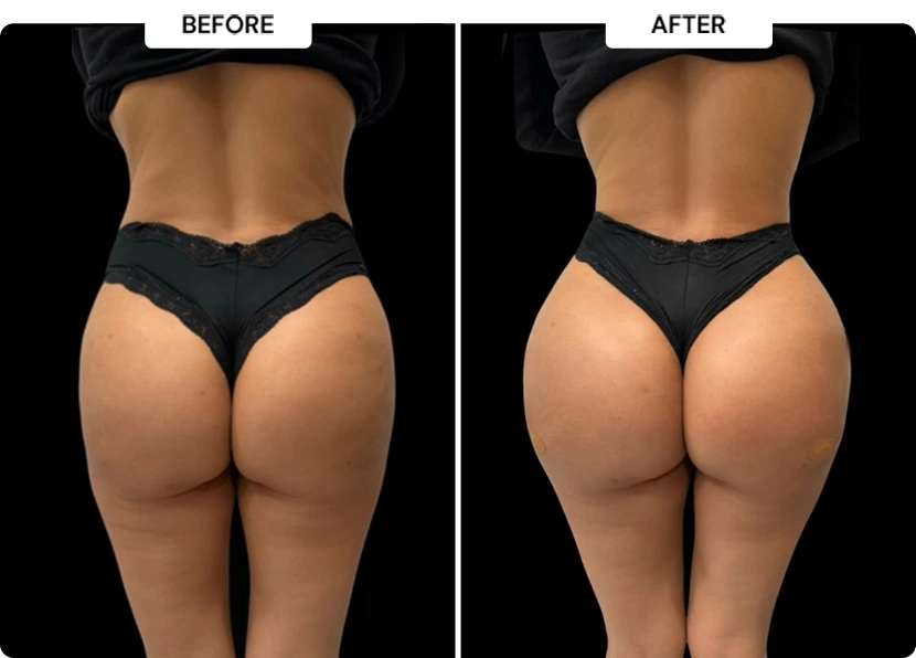 liquid bbl before and after pictures