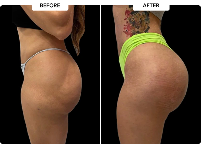 liquid bbl injections near me