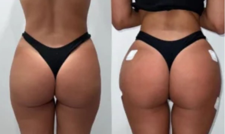 non surgical bbl filler