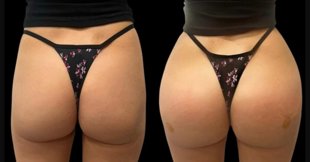 non surgical bbl near me