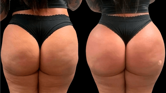 liquid bbl before and after pictures